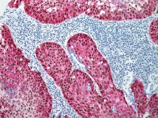 Lung squamous cell carcinoma stained with p63 (DAB) antibody + TRIM29 (FR) antibody