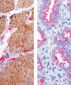 (L) Lung SqCC and Lung adenocarcinoma (R) stained Desmoglein 3 (DAB) + Napsin A (FR)
