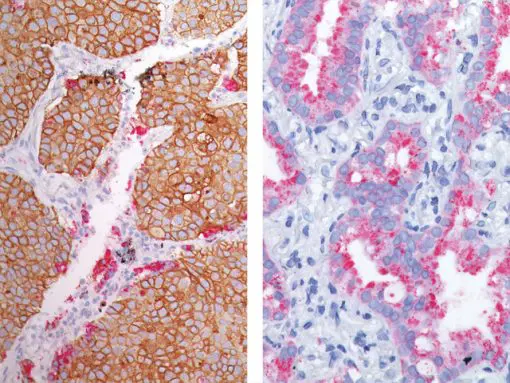 (L) Lung SqCC and Lung adenocarcinoma (R) stained Desmoglein 3 (DAB) + Napsin A (FR)