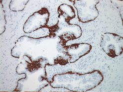 Prostate stained with stained with CK5 antibody