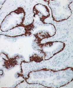 Prostate stained with stained with CK5 antibody