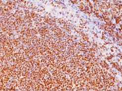 Mantle cell lymphoma stained with Cyclin D1 antibody