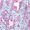 Lung adenocarcinoma stained with Napsin A rabbit antibody