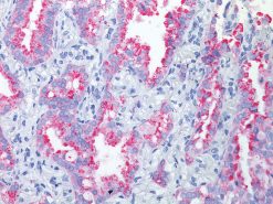 Lung adenocarcinoma stained with Napsin A rabbit antibody