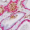 ERG (DAB) + CK5 (FR) in prostate cancer and PIN