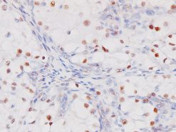Renal cell carcinoma stained with PAX8 antibody (M)
