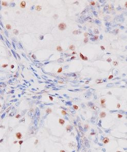 Renal cell carcinoma stained with PAX8 antibody (M)