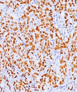 Colon cancer stained with p53 Tumor Suppressor Protein antibody (M)