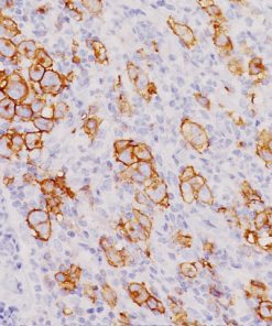 Anaplastic large cell lymphoma stained with CD30 cocktail antibody