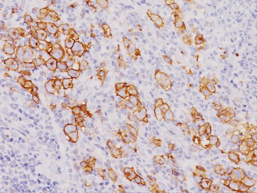Anaplastic large cell lymphoma stained with CD30 cocktail antibody