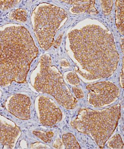 Pancreatic cancer stained with CD56 antibody