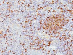 Mantle cell lymphoma stained with CD5 antibody (M)