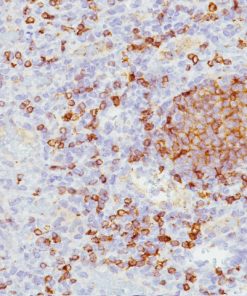 Mantle cell lymphoma stained with CD5 antibody (M)