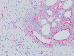 Prostate cancer stained with AMACR Antibody 2x