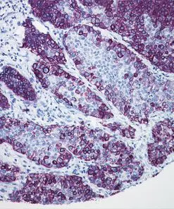 Bajoran Purple staining Squamous Cell Carcinoma with CK5