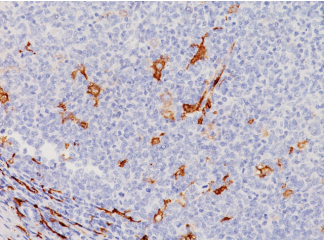  Biocare CD163 macrophage example