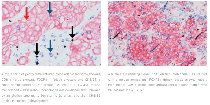 Biocare Triple Stain Examples 