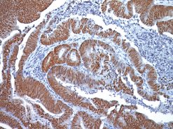 Colon cancer stained with CDX2 antibody