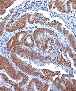 Colon cancer stained with CDX2 antibody