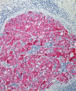 Vulcan Fast Red Chromogen Kit staining melanoma with S100
