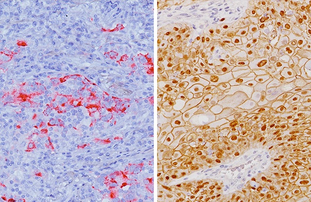 Lung adenocarcinoma stained with Desmoglein