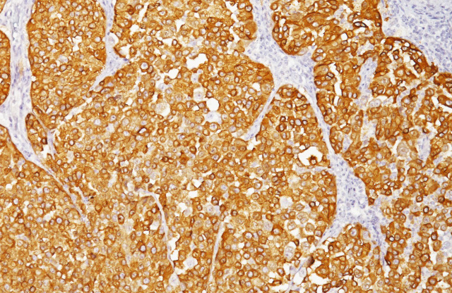 Melanoma labeled with HMB45 + MART-1 + Tyrosinase