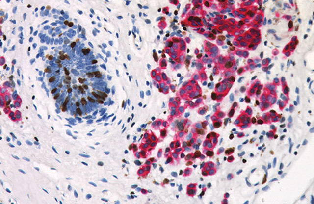 Melanoma labeled with Pan Melanoma + Ki-67