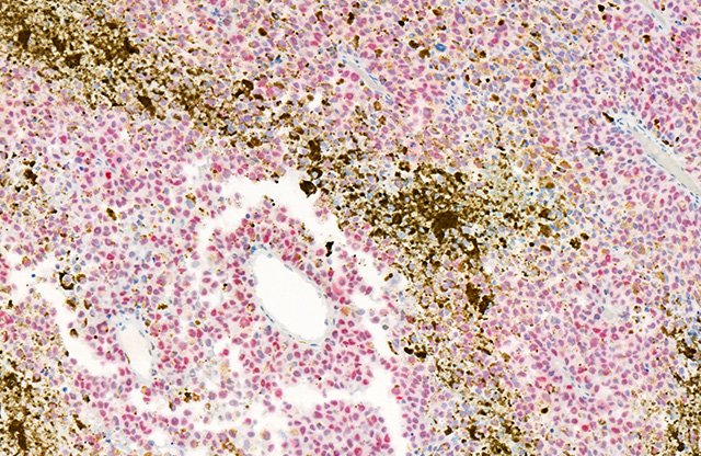 Non-metastatic melanoma stained with PRAME (Red)