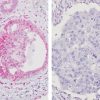 Breast cancer (DCIS) with (L) PTEN deletion & (R) PTEN staining