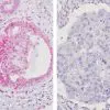 Breast cancer (DCIS) with (R) PTEN deletion & (L) PTEN staining