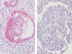 Breast cancer (DCIS) with (L) PTEN deletion & (R) PTEN staining
