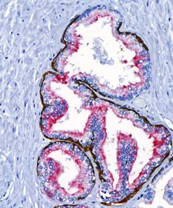 Prostate stained with PIN-4 antibody using ONCORE Pro Hematoxylin