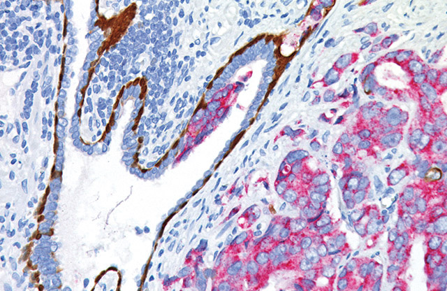 Prostate cancer and prostatic intraepithelial neoplasia