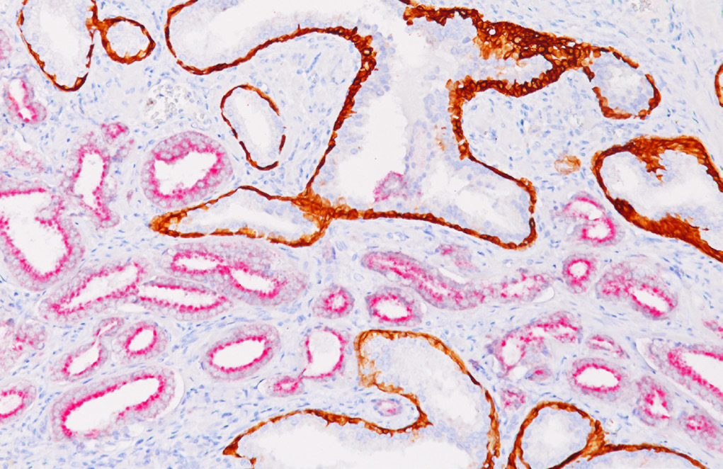 Prostate lesion labeled with Biocare’s CK HMW + p63 + AMACR