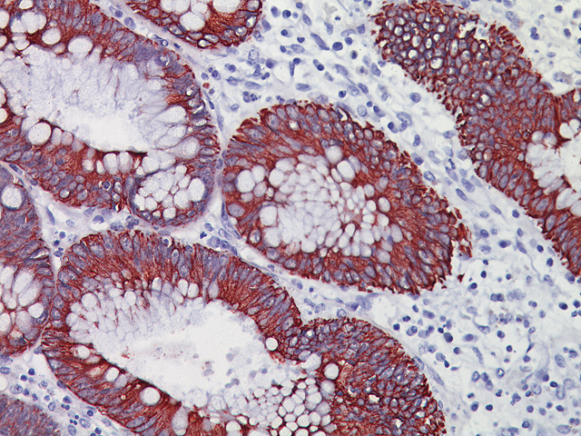 Romulin AEC staining colon cancer with Pan Cytokeratin AE1/ AE3
