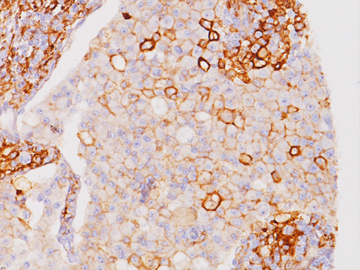 PD-L1 in Melanoma