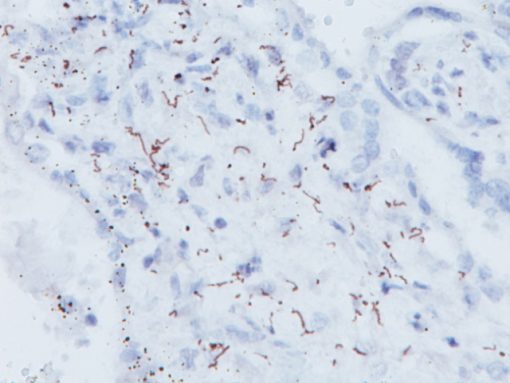 Spirochete infected tissue stained with Treponema pallidum antibody (Spirochete)