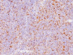 Lymphoma stained with Clusterin antibody