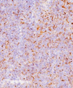 Lymphoma stained with Clusterin antibody