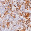 Breast cancer stained with Cytokeratin 7 Antibody