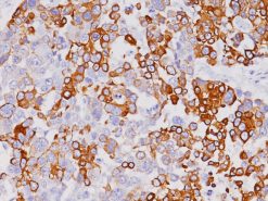 Breast cancer stained with Cytokeratin 7 Antibody