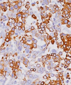 Breast cancer stained with Cytokeratin 7 Antibody