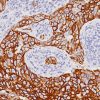 Breast cancer stained with CK7 antibody