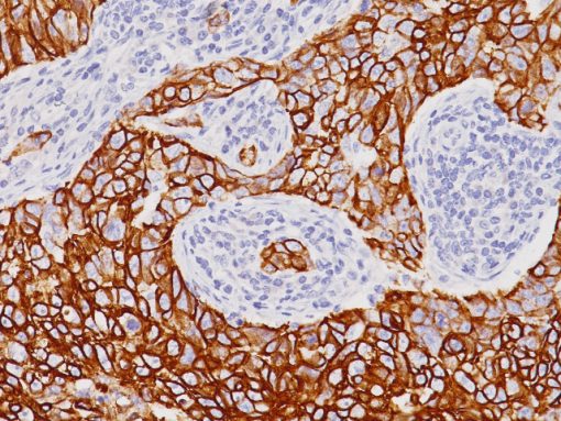 Breast cancer stained with CK7 antibody