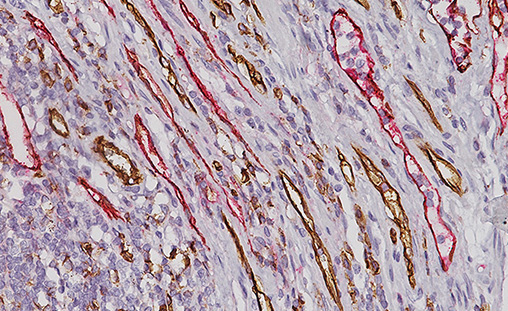 Colon cancer stained with D2-40 + CD31*