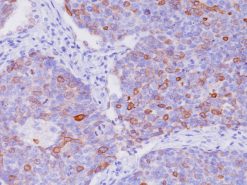 Breast cancer stained with COX-2 antibody