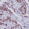 Lung adenocarcinoma stained with TTF-1 antibody