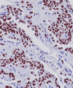 Lung adenocarcinoma stained with TTF-1 antibody