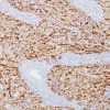 Rhabdomyosarcoma stained with Desmin antibody