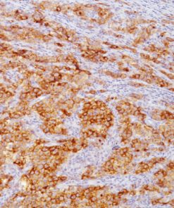 Ovarian dysgerminoma stained with Placental Alkaline Phosphatase antibody (PLAP)